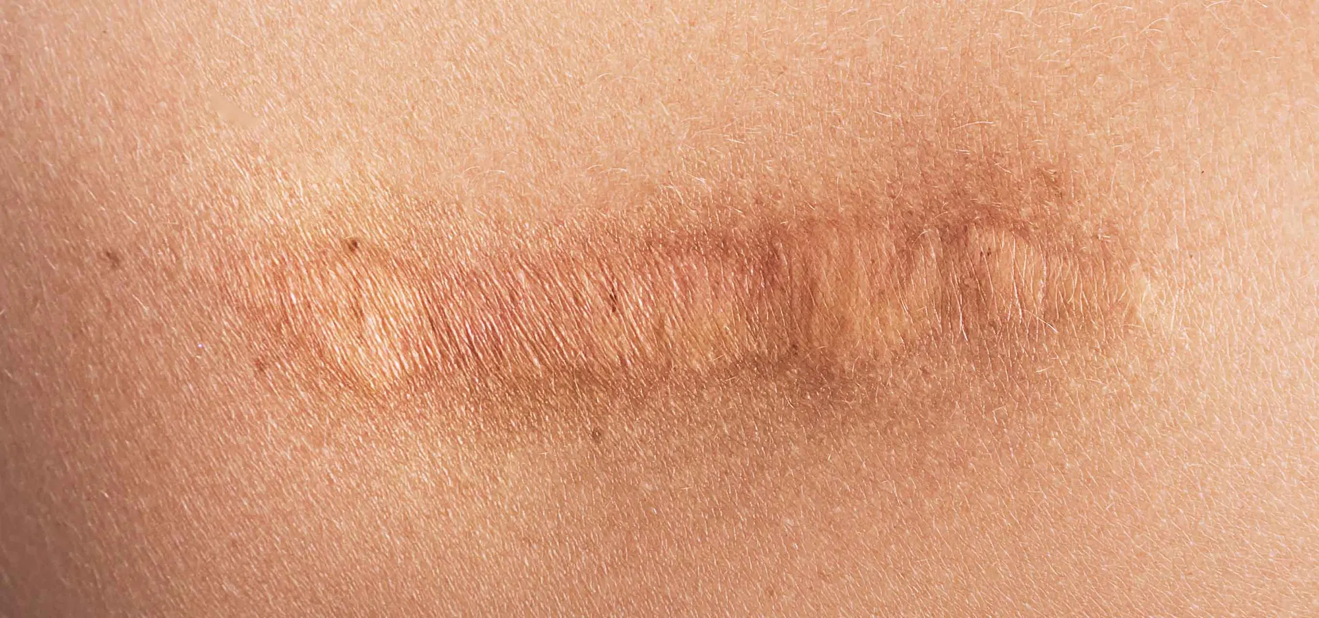 What is a Scar?